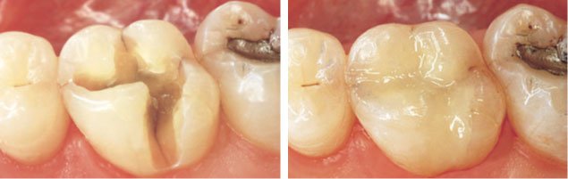 Store dybe revner i 6 års tand før og efter behandling med plast. Foto Tandlæge foreningen