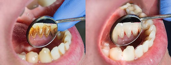 Tænder i undermunden før og efter tandrensning