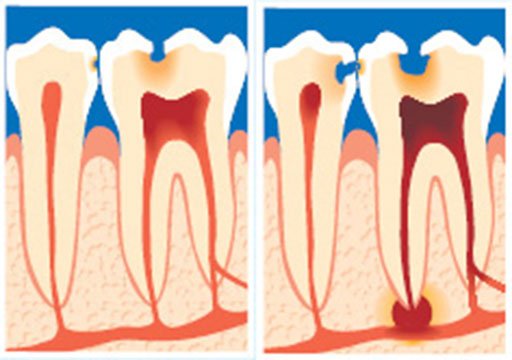 Tand med nervebetændelse/tand med rodspidsbetændelse.